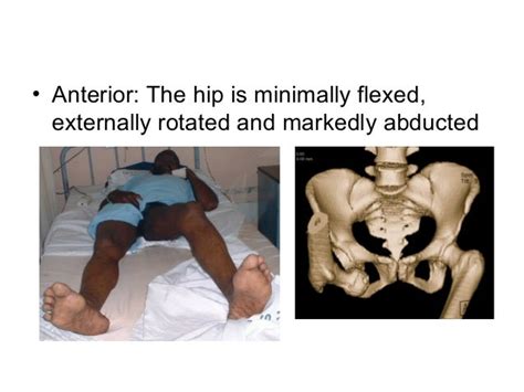 Hip Dislocation Management