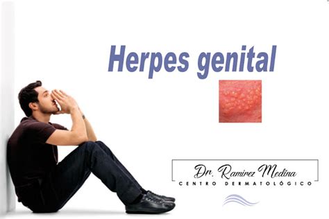 Centro Dermatológico Dr Ramírez Medina Sección Hombres HERPES GENITAL
