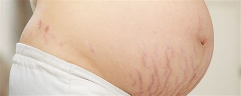 Which Cellulite And Stretch Marks Are Harder To Get Rid Of
