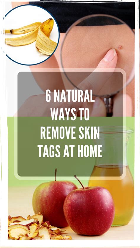 6 natural ways to remove skin tags at home skin tag skin tag removal health remedies