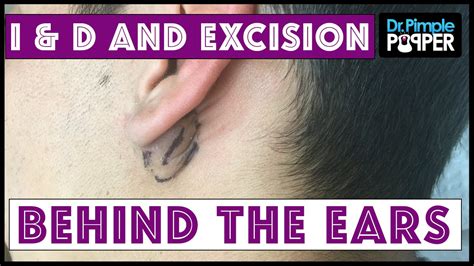 Inflamed And Non Inflamed Cyst Removals Behind Ears Youtube