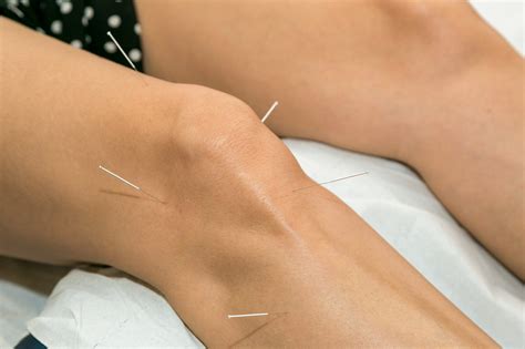 Arthritis Mary Hayden Acupuncture And Tuina Massage Kilkenny