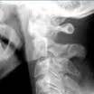 Fractures with Names