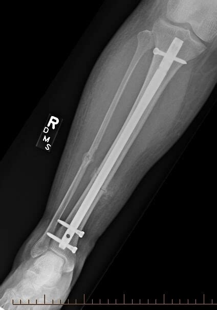 Tibial Shaft Fracture Causes Types Symptoms Diagnosis Vrogue Co