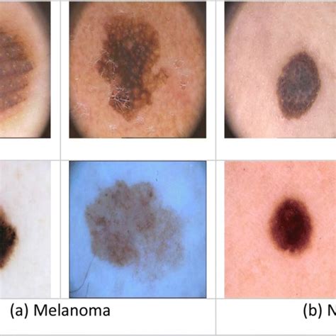 Example Of Features Extraction From A Melanoma And Non Melanoma Skin