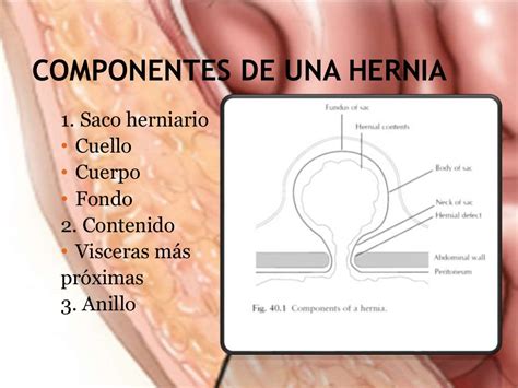 Hernia Femoral O Crural