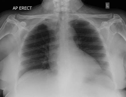 Chest AP Lordotic View Radiology Reference Article Radiopaedia Org