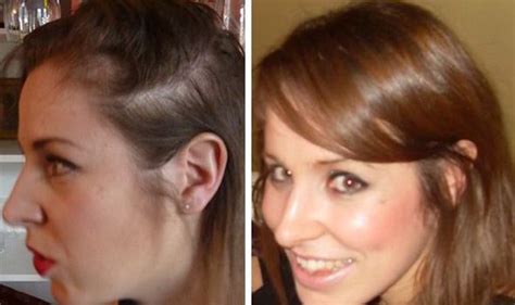 I Learned The Bald Truth About My Hair Loss From Unflattering Christmas