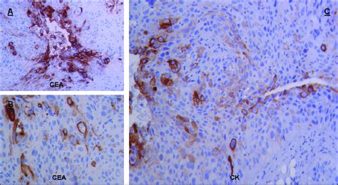 A B Immunohistochemical Stain Shows Positive Tissue Staining For Cea
