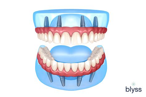 All On 4 Dental Implants Cost Your Guide To Cost Factors And Saving Tips