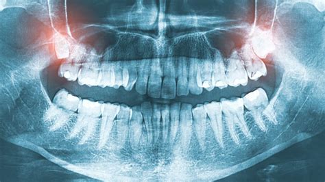 Panoramic X Rays And Ct Scans Polk City Fl Welcome To Kreative Dental