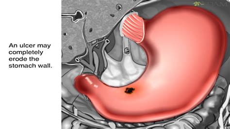 Healthprep.com has been visited by 1m+ users in the past month How Stomach Ulcers Form Animation - Peptic Ulcer Disease ...