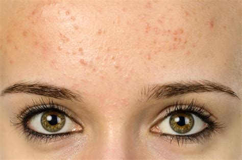 Top 10 How To Cure Pimples On Forehead Naturally In 2022