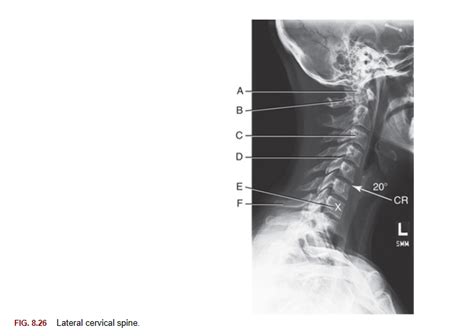 C Spine Lateral View Diagram Quizlet