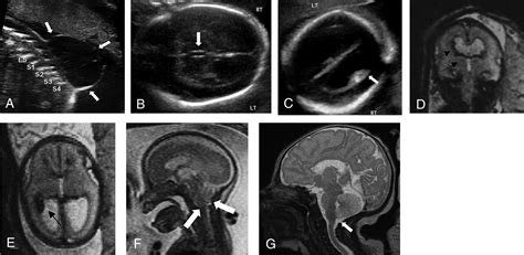 Fetal Intraventricular Hemorrhage In Open Neural Tube Defects Prenatal