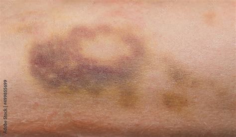 Foto De Bruises On The Human Body Severe Bruise From Impact Bruising
