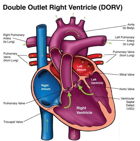 Double Outlet Right Ventricle Repair Surgery And Survival Rate
