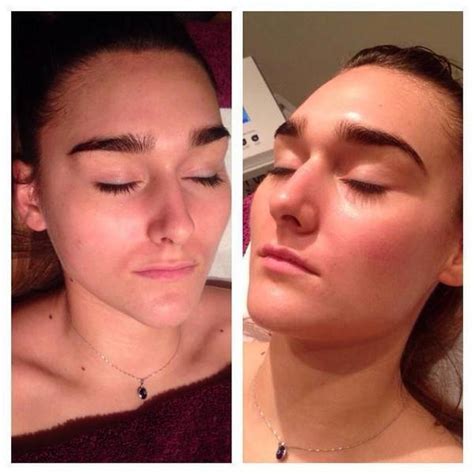 Microcurrent Facial Therapy Before And After Facelift Info