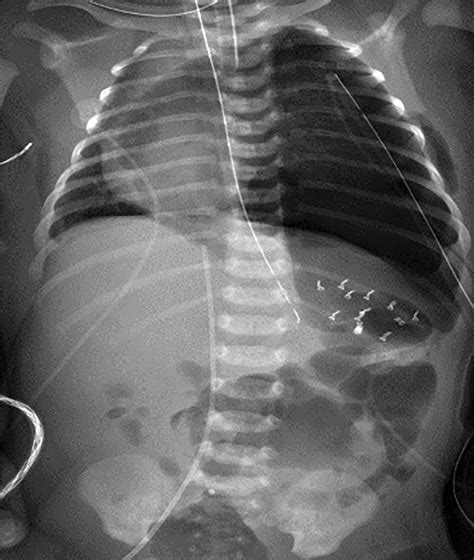 Congenital Diaphragmatic Hernia • Applied Radiology