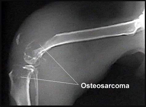 Symptoms of bone cancer in dogs shoulder. What Is Dog Osteosarcoma?