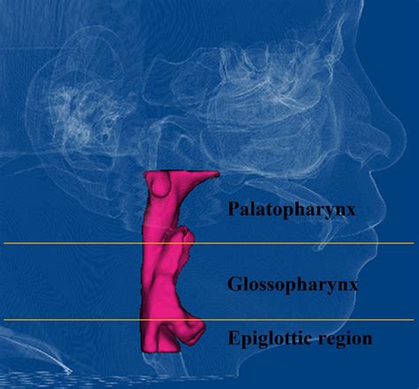 Palatopharynx From Hard Palate To The Caudal Margin Of Palatine Uvula