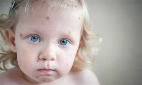 Staph Infection In Babies Pictures Picturemeta