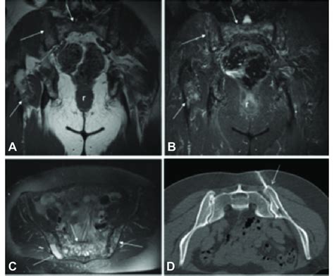Coronal T1 Weighted A And Fat Suppressed T2 Weighted B Mr Images