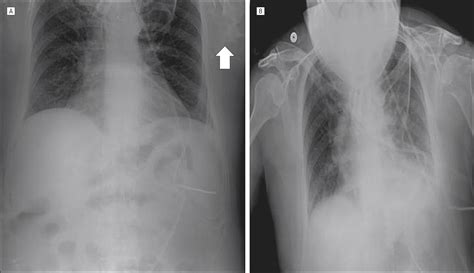 Diagnosis And Management Of A Misplaced Nasogastric Tube Into The Pulmonary Pleura