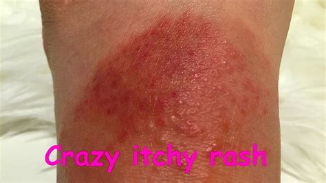 Crazy Itchy Rash And Blisters By Sunburn A Complete Chronology Youtube