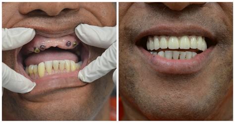 Dental Implants Nyc Best Dental Implants In New York City