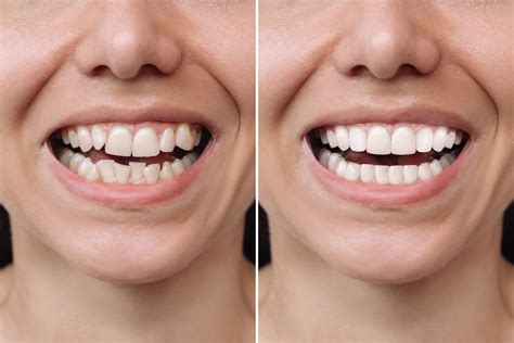 Effective Hydrogen Peroxide Teeth Whitening A Guide