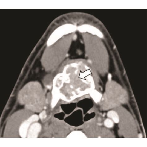 Ct Of The Neck A Axial Noncontrast Ct At The Level Of The Hyoid Bone