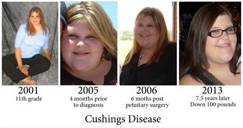 Dr Sherazi Cushings Syndrome