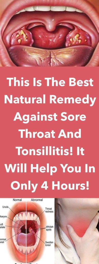 This Is The Best Natural Remedy Against Sore Throat And Tonsillitis It