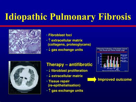 Ppt Idiopathic Pulmonary Fibrosis Powerpoint Presentation Free Download Id3952358