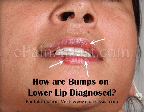 Are Bumps On Lower Lip Contagiouscauses Treatment Home Remedies For