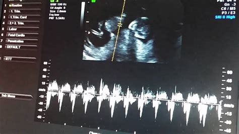 12 Week Ultrasound Nt Scan Youtube