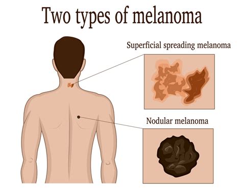 Superficial Spreading Melanoma On Back
