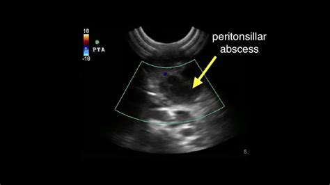 Peritonsillar Abscess Drained W Direct Us Guidance Youtube