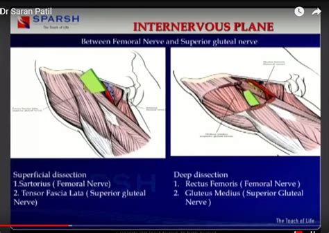 Direct Anterior Approach Hip Replacement Youtube Riset
