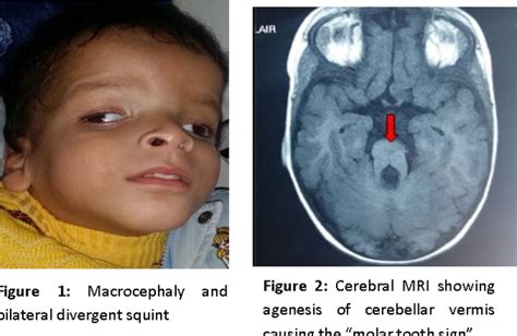 Joubert Syndrome A Rare Developmental Disorder Of Brain Medizzy