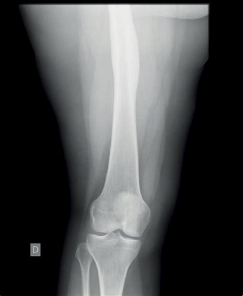 Radiografía Simple De Fémur Distal Proyección Anteroposterior Osteoma
