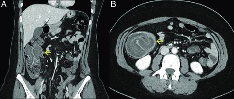 Abdominalpelvic Ct Scan With Contrast A Coronal View Showing Right