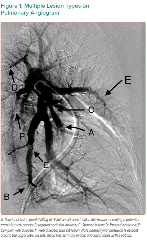 Multiple Lesion Types On Pulmonary Angiogram Radcliffe Cardiology