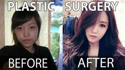 Lilypichu Before Plastic Surgery