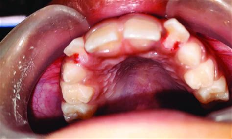 Postoperative Image After The Reduction Of Talons Cusp On The Palatal