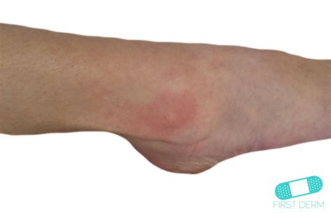 Online Dermatology Hives Urticaria