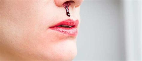 What Makes Your Nose Bleed Epistaxis Upmc Healthbeat
