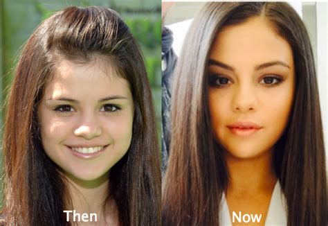 Selena Gomez Plastic Surgery Before And After Photos