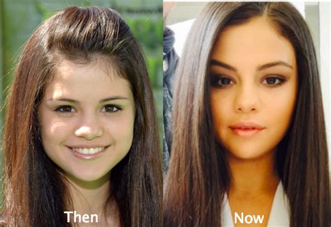 selena gomez plastic surgery before and after photos